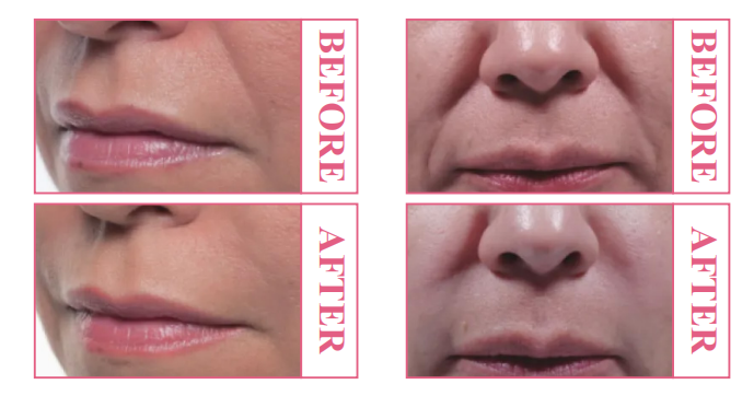 PLLA 前後對比圖