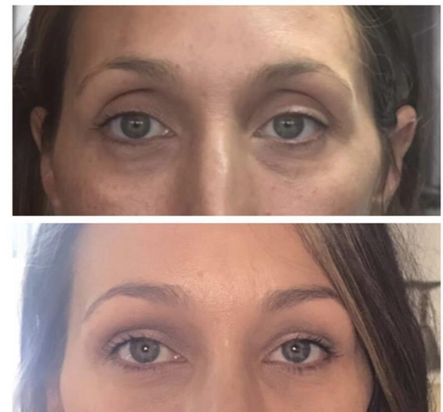 通过注射透明质酸改善眼部区域